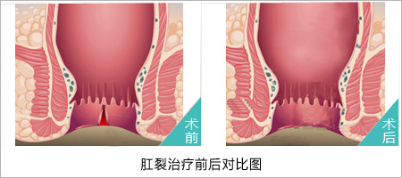 福州肛肠医院