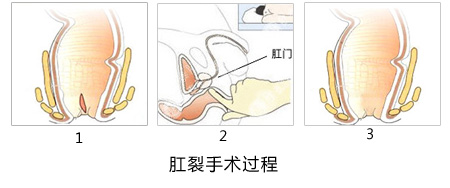 福州肛肠医院