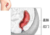 先天性直肠与周围脏器瘘