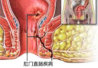 肛门直肠疾病