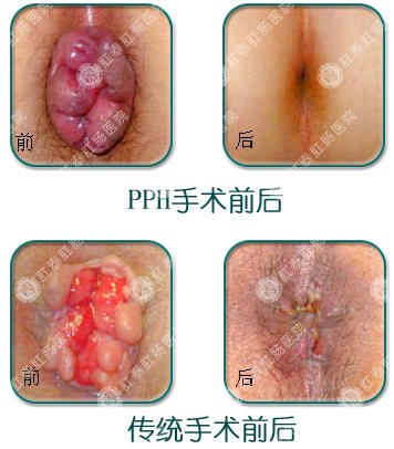 手术与传统手术效果对比