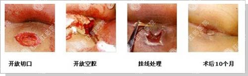 高位复杂肛瘘病例