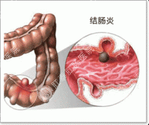 治疗结肠炎的偏方有哪些？