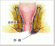 人体患外痔的危害有哪些？