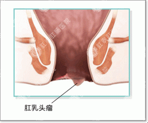 肛窦炎及肛乳头肥大区分治疗