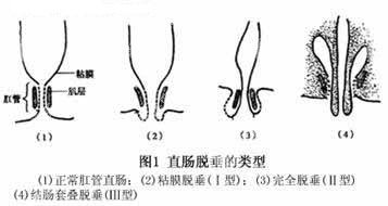 导致脱肛的病因有哪些？