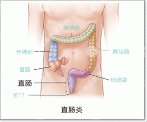 福州医博肛肠医院有限公司：得了急性肠炎怎么办？