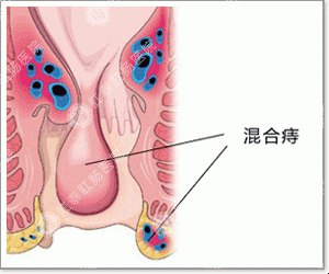 福州女性混合痔是怎么回事？