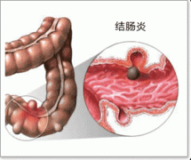 结肠炎