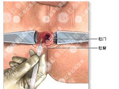 福州肛肠医院